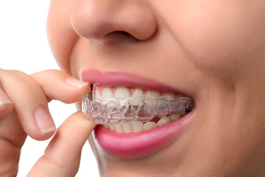 Braces & Invisalign Clear Aligners